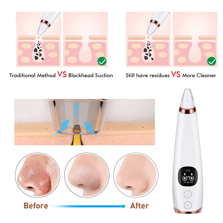 Electric Blackhead Remover Vacuum